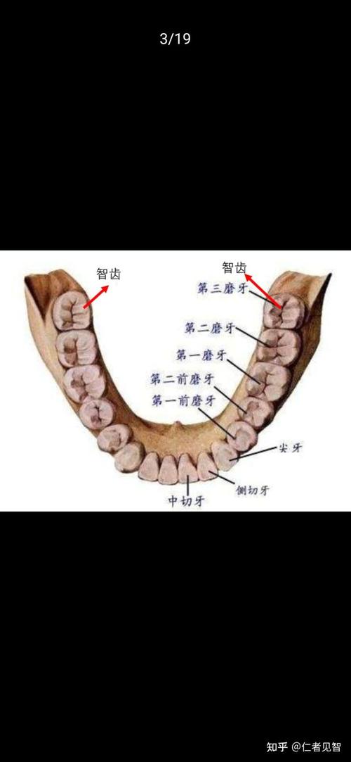 智齿是怎么形成的，智齿是怎么形成的,该如何去掉？  第4张